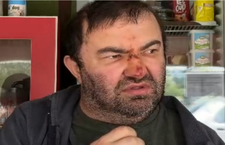 Darp edilen engelli birey Murat Kepil'in şiddet sonrası şişen burnu kanlar içinde.