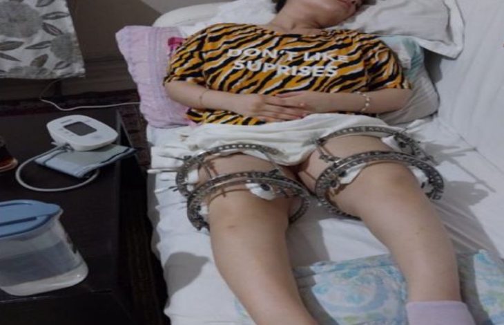 Görselde, hasta yatağında yatan genç bir kadın yer almaktadır. Kadının ayaklarında, ucunda iğneler bulunan demir yapıda bir tıbbi cihaz takılıdır. Yatak çevresinde çeşitli tıbbi ölçüm cihazları da dikkat çekmektedir.