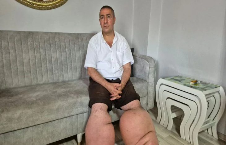 Fil hastalığının sebep olduğu şişkin bacaklarıyla Seyfettin Taşçı koltukta oturuyor.