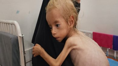 Ciddi derecede yetersiz beslenmiş bir çocuk son derece zayıf, cildi kemiklerine yapışmış durumda ve vücut gelişimi oldukça geri kalmış görünmektedir. Saçları ince ve seyrek, yanakları çökmüş, gözleri büyük ve hüzünlüdür. Çocuk, siyah çarşaf giymiş bir yetişkin kadına sıkı sıkıya sarılmıştır.