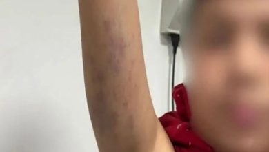 Kolu morarmış otizmli öğrenci.