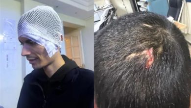 Görselde, sol tarafta başına koruyucu bir bandaj takılmış engelli genç, sağ tarafta küçük bir yara ve dikiş atılan kafa taşının yakın plan görüntüsü yer almaktadır.