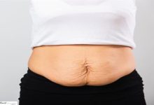 Beyaz bir arka plan önünde, bir kişinin alt karın bölgesi yakın plandan görülüyor; doğum sonrası oluşan gevşeme ve bombelik net şekilde dikkat çekiyor.