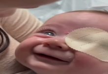 Yakın çekimde bir bebeğin yüzü görülüyor. Bebeğin bir gözü bantla kapatılmış, diğer gözü açık ve parlak şekilde bakıyor. Gülümseyen bebek neşeli bir ifade sergilerken, yanında ona yakın duran bir yetişkinin kolu da kadraja girmiş.