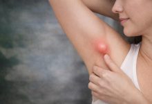 Bir kadın koltuk altını kaldırmış, parmağıyla kızarık ve şiş bir bölgeyi işaret ediyor. Şişlik belirgin, yuvarlak ve iltihaplı gibi görünüyor; çevresi hafif kızarmış. Görsel, koltuk altındaki ağrılı bir şişliği ya da enfeksiyonu çağrıştırıyor.