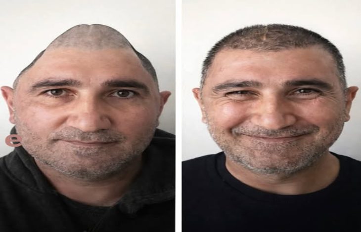 Yan yana iki portre fotoğrafı yer alıyor. Aynı erkeğin ameliyat öncesi ve sonrası hâli gösterilmiş. Solda başının üst kısmında ciddi bir şekil bozukluğu dikkat çekerken, sağdaki görüntüde kafatası daha düzgün görünüyor ve kişi hafifçe gülümsüyor. Yüz ifadesi daha rahat ve toparlanmış bir izlenim veriyor.