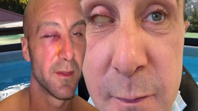 Yan yana yerleştirilmiş iki yakın plan yüz görüntüsünde, iki kişinin göz çevresinde ciddi hasar dikkat çekiyor. Soldaki kişinin gözü morarmış ve akıntı var; sağdaki kişinin ise bir gözü ciddi şekilde şişmiş ve kapalı. Görseller, ağır bir göz yaralanmasını vurgulayan çarpıcı bir durum sunuyor.