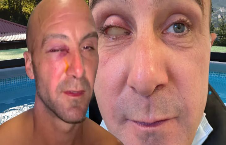 Yan yana yerleştirilmiş iki yakın plan yüz görüntüsünde, iki kişinin göz çevresinde ciddi hasar dikkat çekiyor. Soldaki kişinin gözü morarmış ve akıntı var; sağdaki kişinin ise bir gözü ciddi şekilde şişmiş ve kapalı. Görseller, ağır bir göz yaralanmasını vurgulayan çarpıcı bir durum sunuyor.