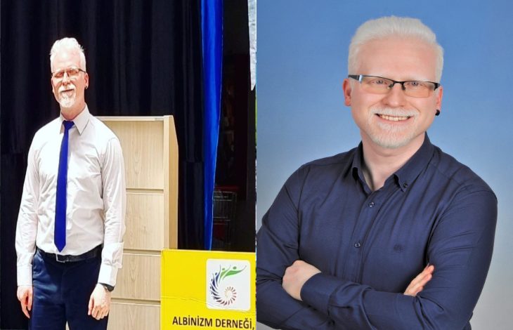 Görselde iki ayrı karede aynı kişi yer alıyor. Solda bir etkinlik alanında resmi kıyafetle ayakta dururken, yanında “Albinizm Derneği” logosunun bulunduğu bir kürsü görülüyor. Sağda ise mavi fon önünde çekilmiş profesyonel bir portre fotoğrafı yer alıyor. Görsel, albinizm farkındalığı ve temsil çalışmalarına odaklanan bir içerik izlenimi veriyor.