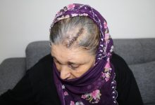 Kafasına kürekle vurulan kadının kafatasına atılan dikişler.
