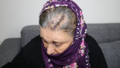Kafasına kürekle vurulan kadının kafatasına atılan dikişler.