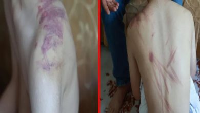 İki kolaj fotoğrafta, çocuğun omuz ve sırtında darp izleri bulunuyor.