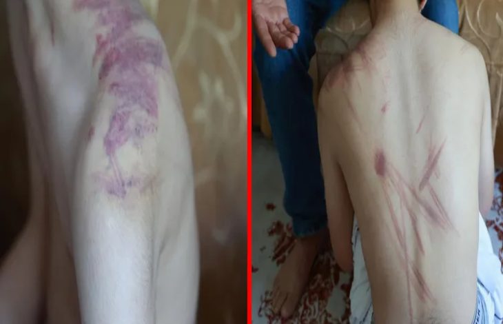 İki kolaj fotoğrafta, çocuğun omuz ve sırtında darp izleri bulunuyor.