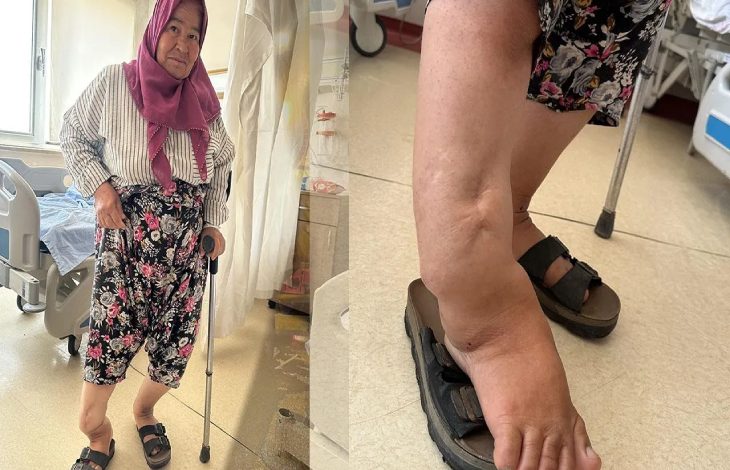 Operasyon geçiren Sultan Kazak, ilk kolaj fotoğrafta koltuk değneği tutarak ayakta durmakta. İkinci kolaj da ise bacak deformitesi ekrana yansıyor.