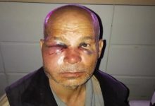 Muhammed Sonbaş'ın yüzünün özellikle sol göz çevresinde belirgin şişlik, morarma ve kesik bulunan, ciddi şekilde yaralanmış görülüyor.